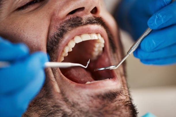 Best Emergency Treatment for Toothache in Iowa, LA